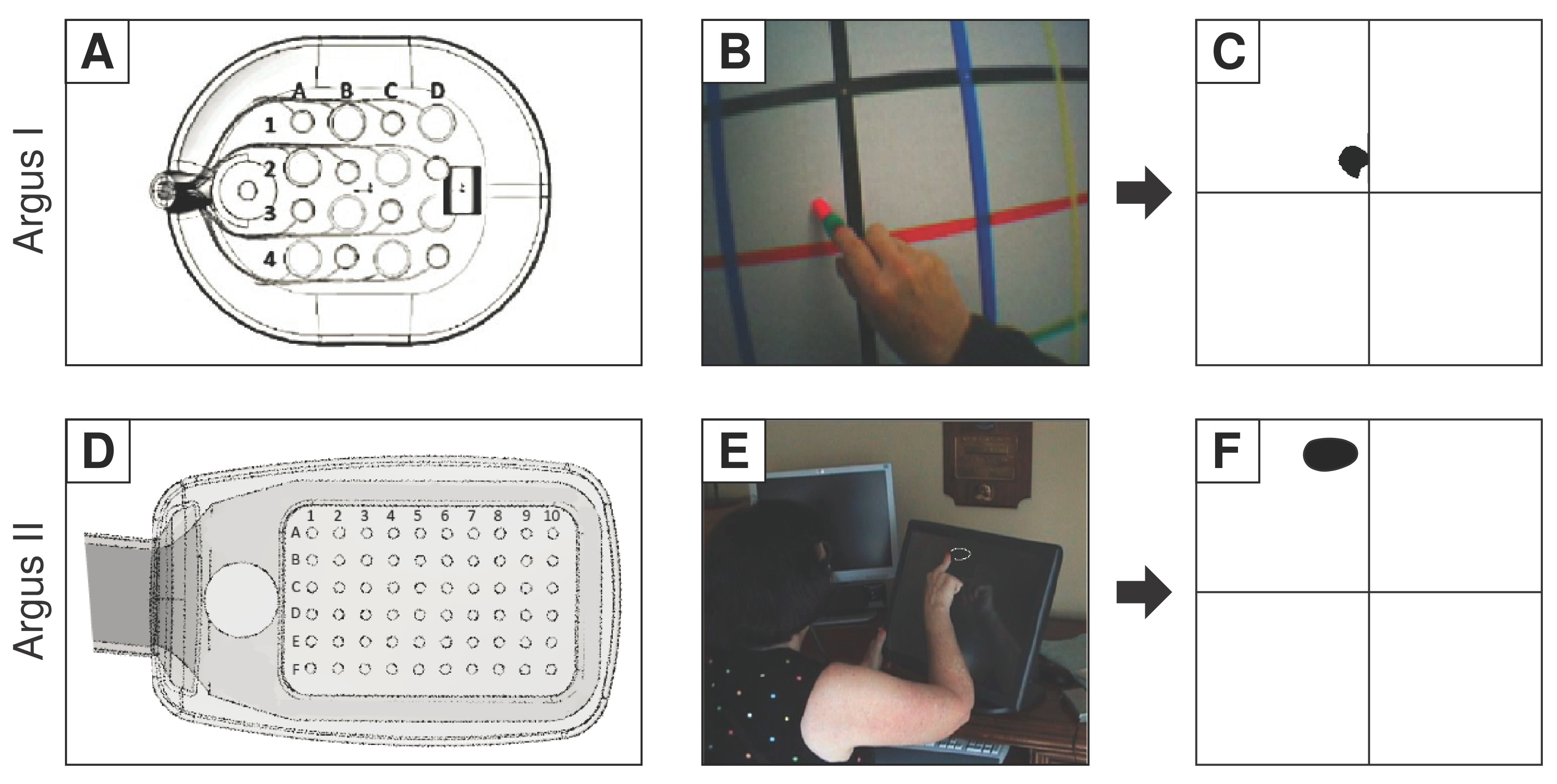 Panels A and D show an example of an invasive BCI, the retinal prosthetic Argus II. The array is designed to artificially stimulate neurons in the retina.